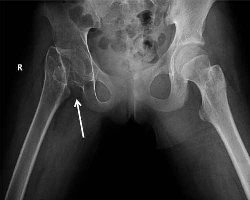 Femur fracture diagnosis and orthopedic treatment